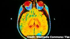 Scientists See Similarities Between Alzheimer's, Concussions